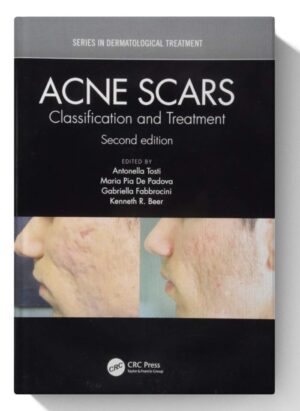 Acne Scars: Classification and Treatment, Second Edition (Series in Dermatological Treatment) 2nd Edition, Kindle Edition