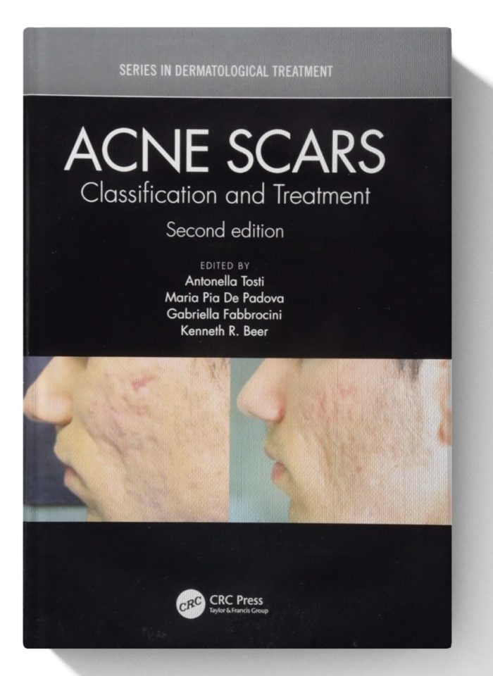 Acne Scars: Classification and Treatment, Second Edition (Series in Dermatological Treatment) 2nd Edition, Kindle Edition